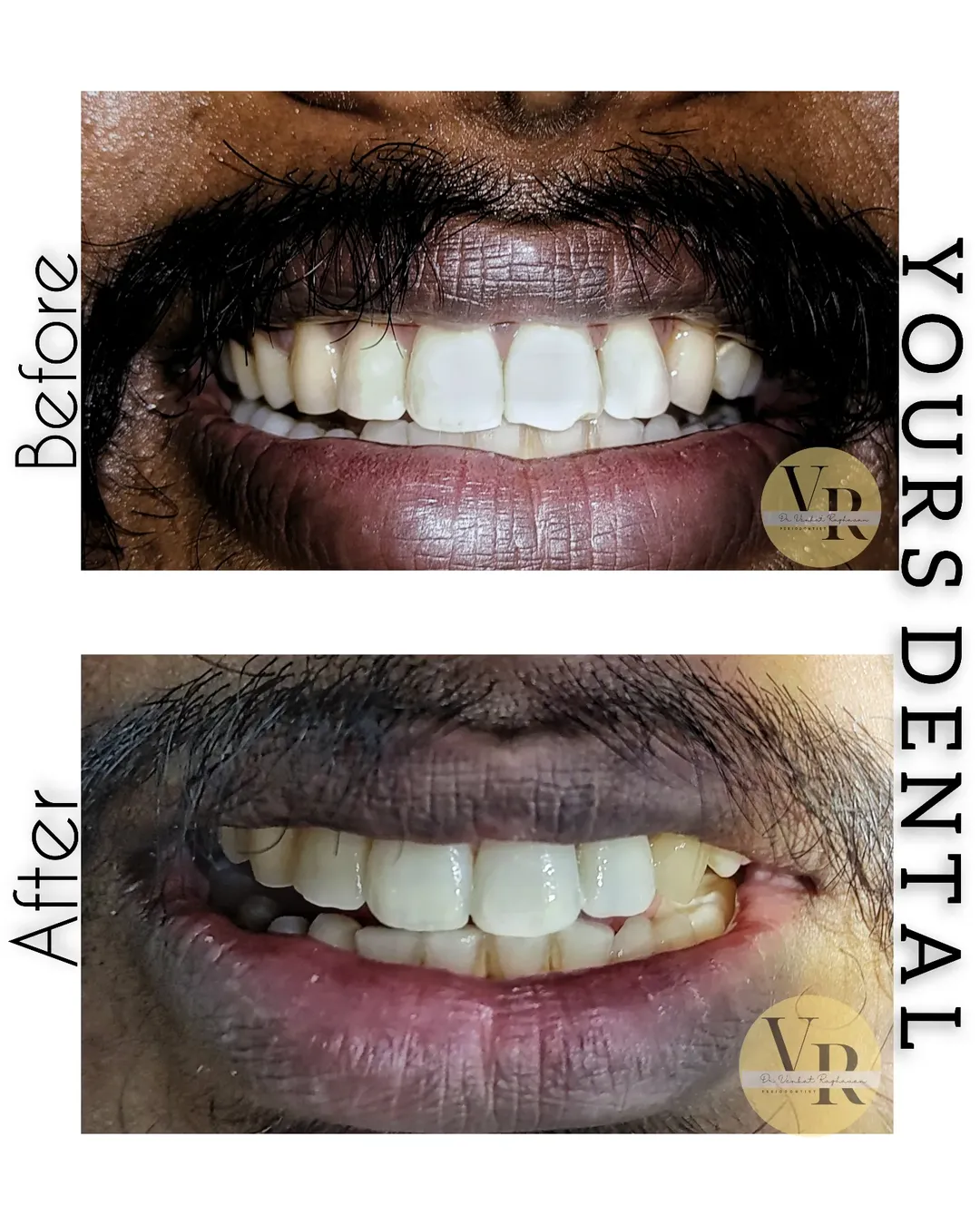 Smile Reconstruction Before After