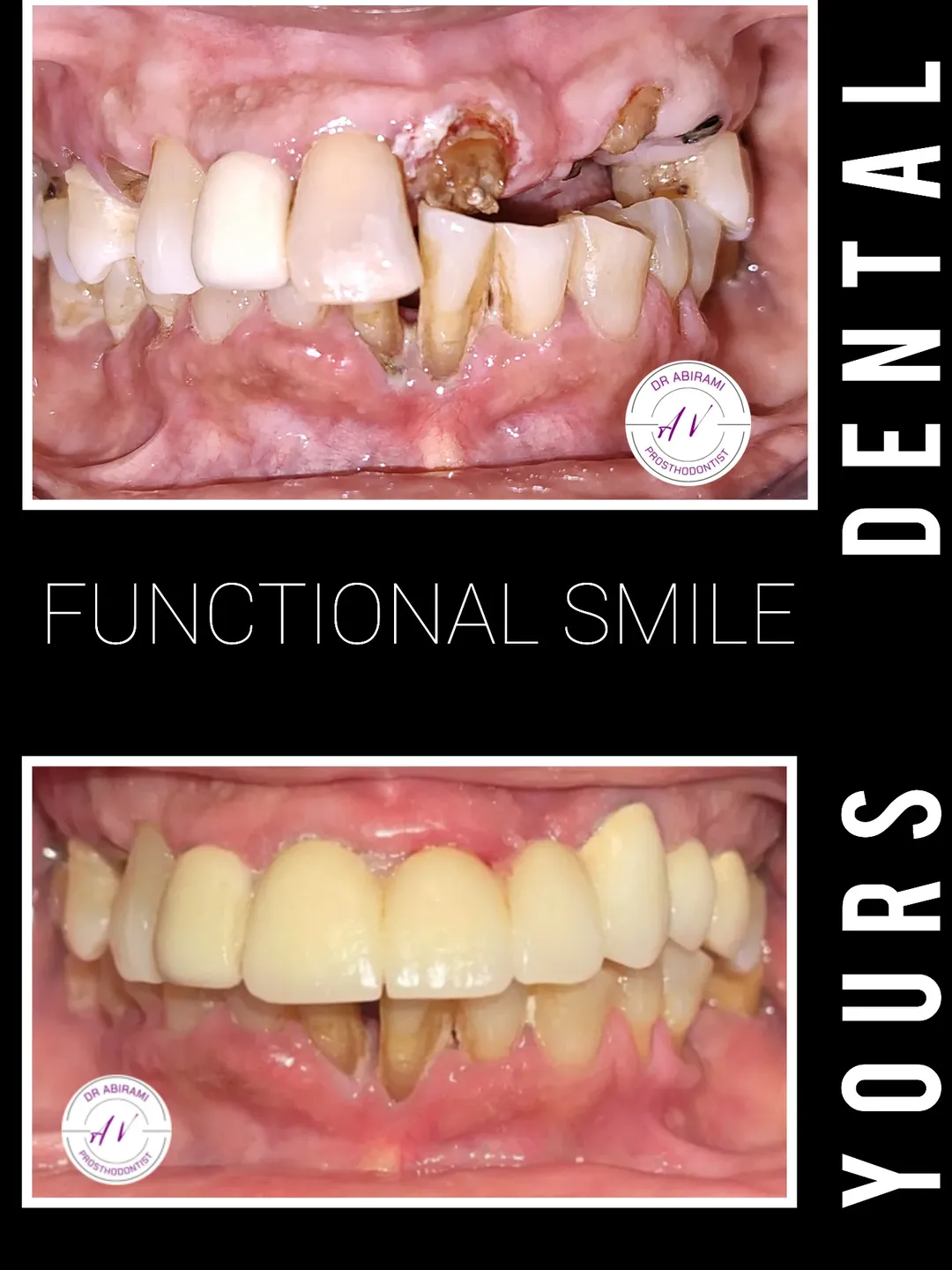 Functional Smile Restoration