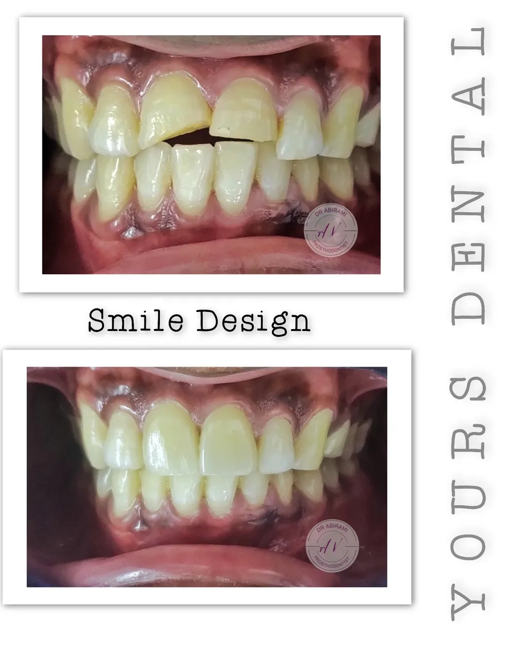Smile Design
