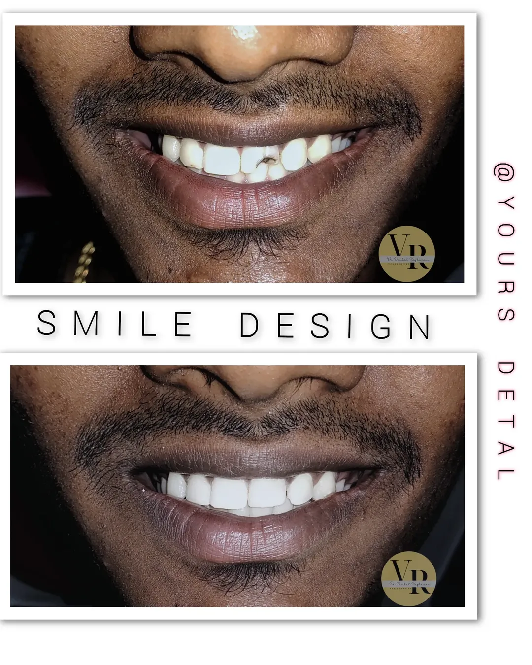 Caries Removal Smile Correction