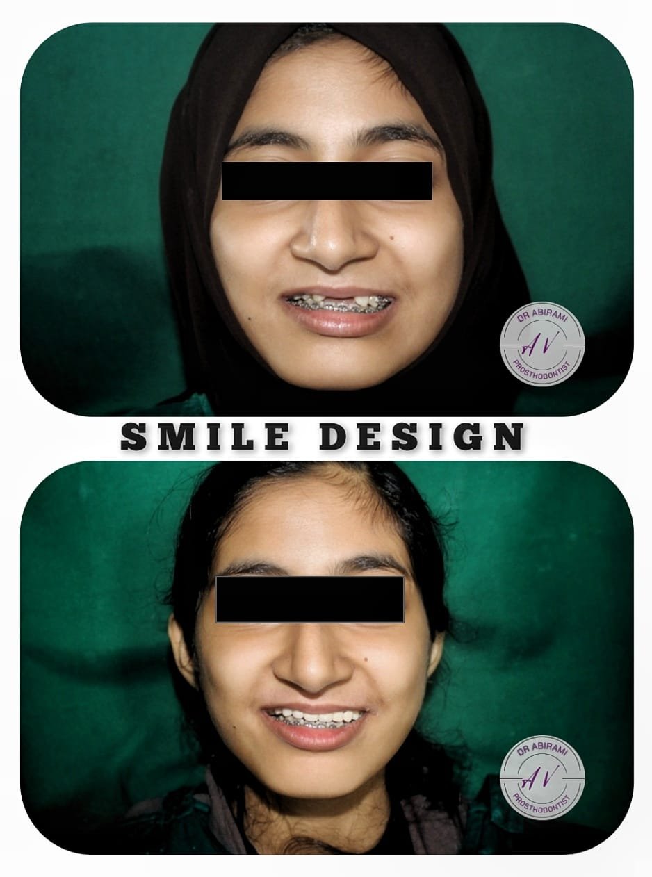 Smile Design Before After