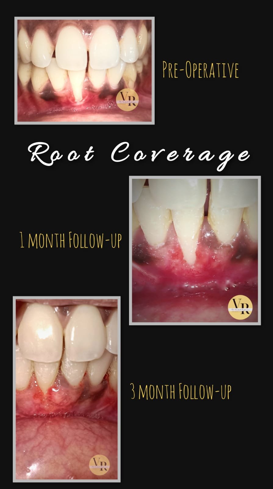 Smile Design Restoration