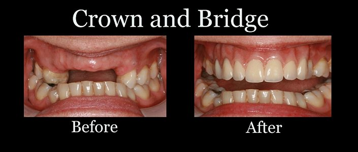 Dental Crowns & Bridges